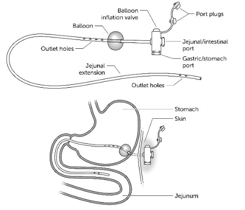 G-J tube
